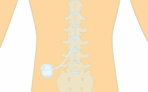 abbott burst spinal cord stimulator annual cost